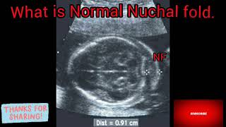 What is Nuchal fold on ultrasound [upl. by Delahk]