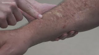 Skin Cancer How to spot melanoma warning signs [upl. by Nylsirk]