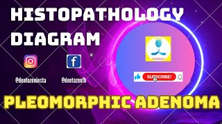 Histopathology diagram of Pleomorphic Adenoma [upl. by Ahseyk]