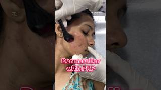 Dermaroller with PRP for acne scarsකුරුලෑ කැලැල් සඳහා ප්‍රතිකාර skincenter acnescars skincare [upl. by Emory741]