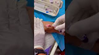 IV Insertion  viral video  Like Share Subscribe amp Follow 👍 [upl. by Budwig]