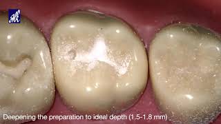 Class I Cavity Preparation Tooth 17 [upl. by Elliott]