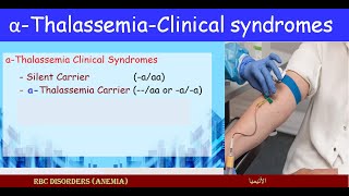 Lecture 251 Carriers alfa Thalassemia  Clinical Syndromes [upl. by Joshia991]