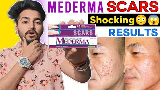 Mederma Cream  Mederma Scar Cream  Mederma Cream Ke Fayde [upl. by Dnob]