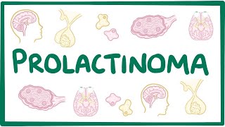 Prolactinoma  causes symptoms diagnosis treatment pathology [upl. by Lalaj675]