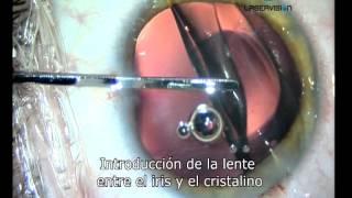 Lente intraocular para el tratamiento de la miopia hipermetropia y astigmatismo [upl. by Anivahs653]