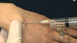 wrist ganglion aspiration [upl. by Holds]