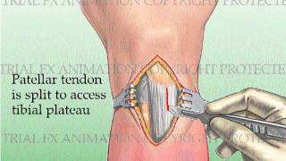 Tibial Fracture repair with Titanium Intramedullary Rod [upl. by Wesla]