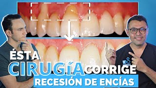 ¿Cómo recuperar una ENCÍA RETRAÍDA  CASO REAL Antes y Después  Cirugía de recesión gingival [upl. by Katrine484]