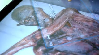 Injuries on the body of Ötzi the Iceman [upl. by Cornia]