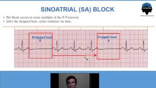 6 Bloqueo o Paro Sinusal [upl. by Euqnimod299]