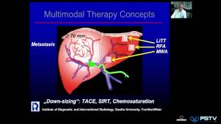 Professor Vogel Intervention Oncology [upl. by Htir]