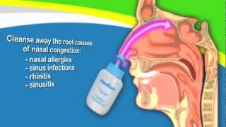 Nasal Irrigation to Treat Sinusitis Common Cold Allergy Better Than Neti Pots [upl. by Airpac]