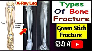 Green Stick Fracture Of Leg bone  Type of Fracture  Xray Leg Padiatric  Uday X Ray [upl. by Ellswerth]