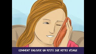 Comment enlever un kyste sur votre visage [upl. by Schulein499]