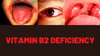 VITAMIN B2 BENEFITS FOOD SOURCES DEFICIENCY SYMPTOMS [upl. by Adlemi]