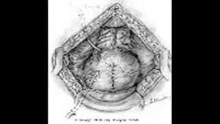 urology lecturs 4suprapubic Prostatectomy [upl. by Ahsitneuq]