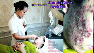 acneblackheadsacne treatmentcystic điều trị mụnnặn mụn hiệu quả tại Hien Van Spa383Đại Nghĩa [upl. by Kaczer]