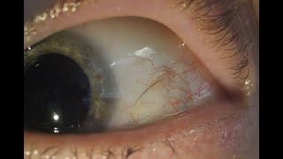 Subconjunctival eyelash removal [upl. by Stacie758]