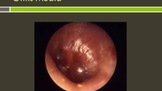 Otitis Externa and Otitis Media [upl. by Parsons144]