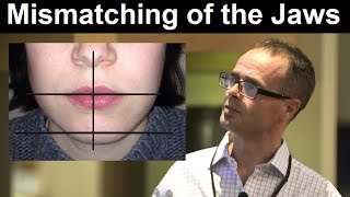 Effect of Midline Discrepancy Mismatching or Facial Asymmetry on Facial Appearance by Dr Mike Mew [upl. by Htrow]