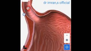 Esophegial squamus cell carcinoma [upl. by Akira437]