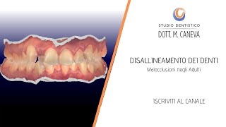 DISALLINEAMENTO dei DENTI  Malocclusioni negli Adulti  Studio Dentistico Dott M Caneva [upl. by Roch]