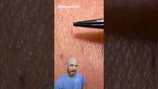 These ingrown hair pulls are super satisfying credit blemishbandits on TT doctor satisfying [upl. by Connett]