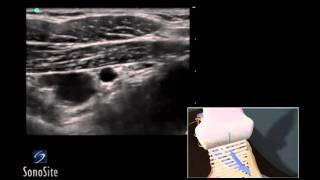 How To Infraclavicular Nerve Block 3D Video [upl. by Clarette598]