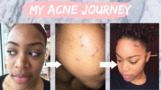 My Acne Journey  How I Cleared My Skin Using Tretinoin [upl. by Ethelbert]