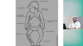 Rickets  Dr Abdulmoein AlAagha‎ [upl. by Latsirk]