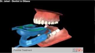 Preventive  Fluoride Treatment  Dentist Ottawa [upl. by Emawk800]