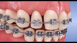 Orthodontie  Comment resserrer ses dents avec des bagues [upl. by Bernadette]