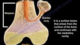 Osteochondroma  solitary and multiple  Everything You Need To Know  Dr Nabil Ebraheim [upl. by Nosnarb]