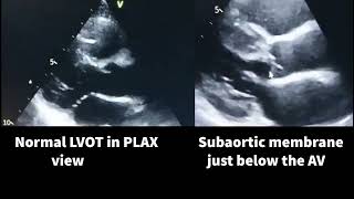 Subaortic membrane stenosis [upl. by Hugh]