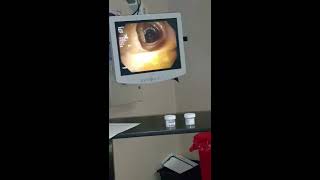 Colonoscopy without sedation live while performing procedure [upl. by Marybeth]