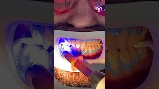 Teeth whitening process [upl. by Uy]