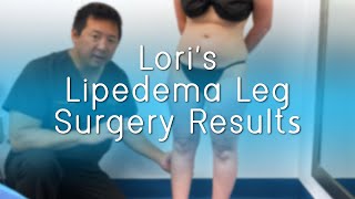 Lipedema Leg Surgery Results  Liposuction  Ankles Calves Knees  ArtLipo  Expert Dr Thomas Su [upl. by Arlan]