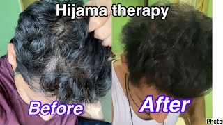 Hijama therapy for hair growth my ￼ experience educational hairgrowth [upl. by Yeh]