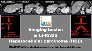 Imaging for Liver Cancer amp LIRADS Hepatocellular carcinoma radiology masterclass  Edusurg clinics [upl. by Wivinia]