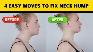 Say Goodbye to Dowagers Hump 4 Quick Yoga Moves for Fixing Neck Hump [upl. by Maddeu]