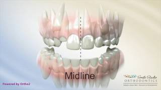 Midline Shift Due to Blocked Out Teeth  Orthodontic Treatment [upl. by Kristie662]