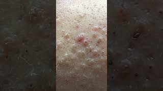 Lets Count Acnes  ACNE TREATMENT MAI NGOC FAMILY 💕💕  ACNE TREATMENT MAI NGỌC  demo [upl. by Kenay]