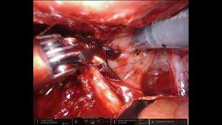 Stage 4 Endometriosis surgery [upl. by Radu]