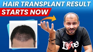 My Shedding Phase After Hair Transplant Completed  Time To See The Real Hair Transplant Result [upl. by Are]