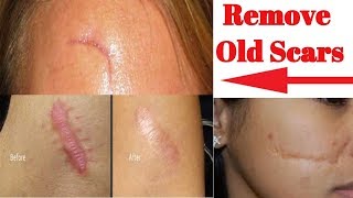 How to Get Rid of Scars Fast Best Scar Treatment Home remedies for scars  Remove old scars [upl. by Neerod239]