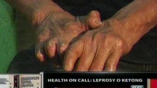 OC Health On Call Leprosy o Ketong [upl. by Gambrell]