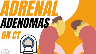 Adrenal adenomas on CT  a diagnostic approach [upl. by Akeemat803]