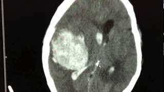 Brain Hemorrhage  hemorrhagic stroke [upl. by Steve]