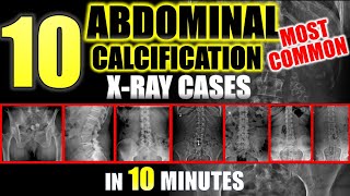 Abdominal Calcifications on XRay  10 Most Common radiology [upl. by Tallula]